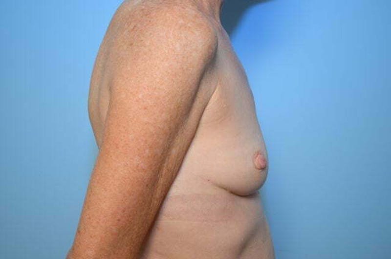 Breast Augmentation Before & After Gallery - Patient 223620 - Image 5