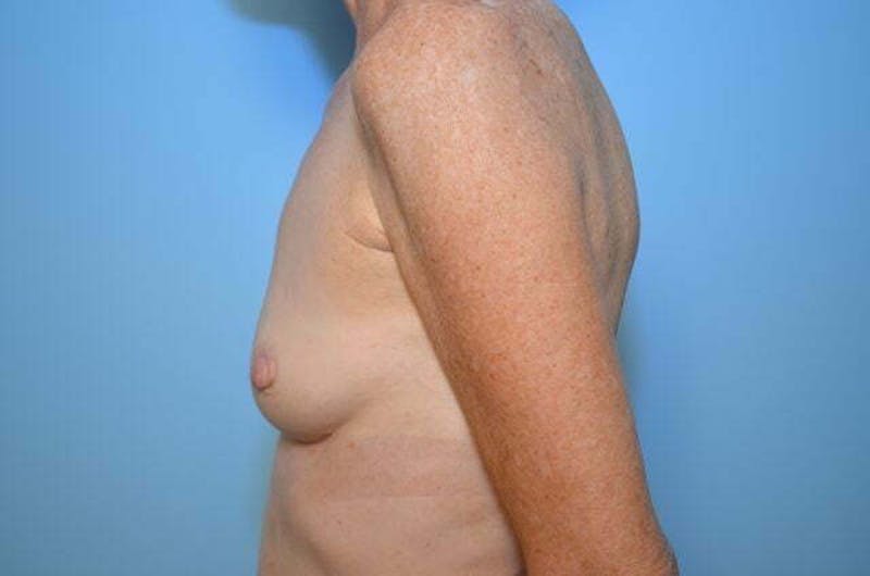 Breast Augmentation Before & After Gallery - Patient 223620 - Image 9