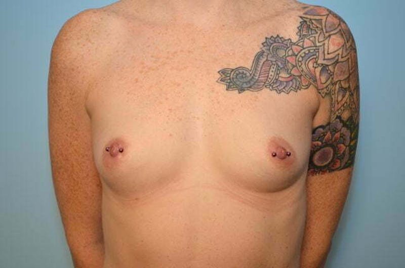 Breast Augmentation Before & After Gallery - Patient 387296 - Image 1