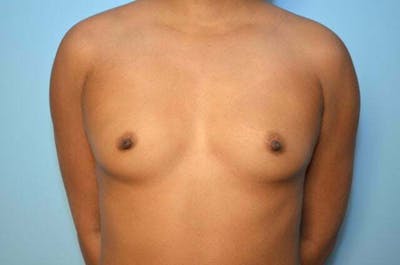 Breast Augmentation Before & After Gallery - Patient 222222 - Image 1