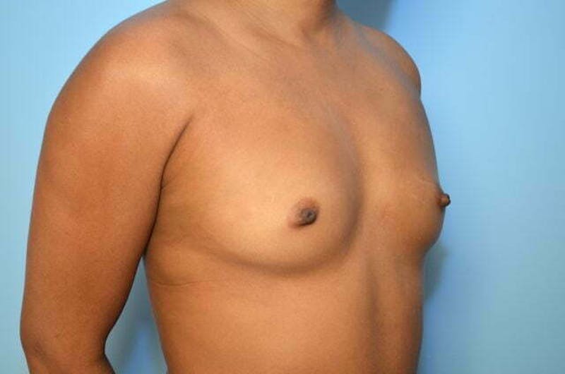 Breast Augmentation Before & After Gallery - Patient 222222 - Image 3