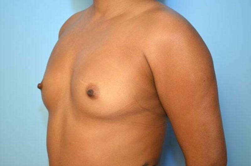 Breast Augmentation Before & After Gallery - Patient 222222 - Image 7