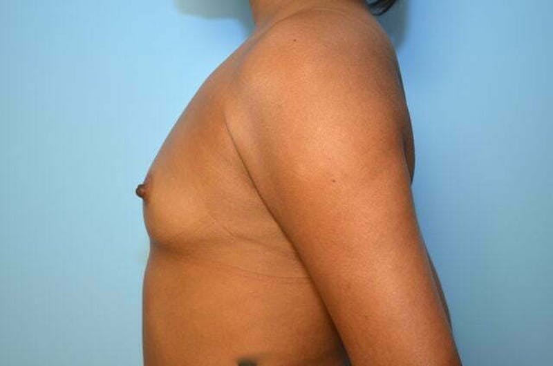 Breast Augmentation Before & After Gallery - Patient 222222 - Image 9