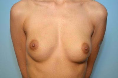 Breast Augmentation Before & After Gallery - Patient 409119 - Image 1