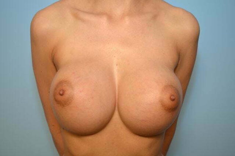 Breast Augmentation Before & After Gallery - Patient 409119 - Image 2