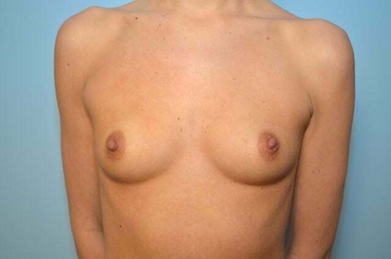 Breast Augmentation Before & After Gallery - Patient 191541 - Image 1