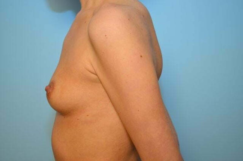 Breast Augmentation Before & After Gallery - Patient 191541 - Image 9