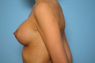 Breast Augmentation Before & After Gallery - Patient 191541 - Image 10