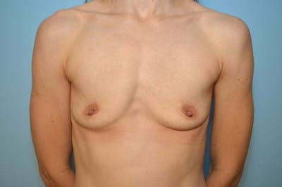 Breast Augmentation Before & After Gallery - Patient 138909 - Image 1