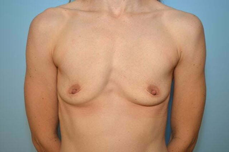 Breast Augmentation Before & After Gallery - Patient 138909 - Image 1