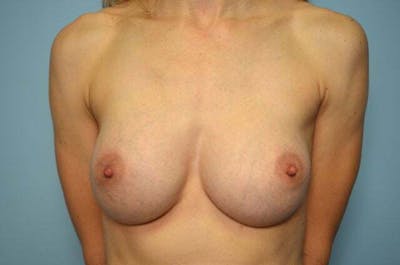 Breast Augmentation Before & After Gallery - Patient 138909 - Image 2