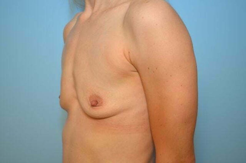 Breast Augmentation Before & After Gallery - Patient 138909 - Image 7