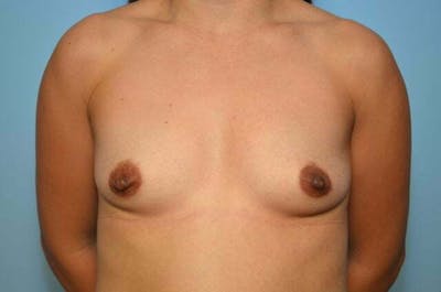 Breast Augmentation Before & After Gallery - Patient 304361 - Image 1