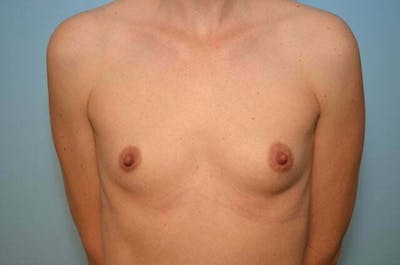 Breast Augmentation Before & After Gallery - Patient 867839 - Image 1