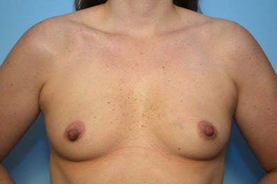 Breast Augmentation Before & After Gallery - Patient 136995 - Image 1