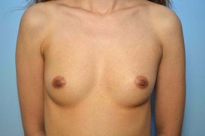 Breast Augmentation Before & After Gallery - Patient 903097 - Image 1
