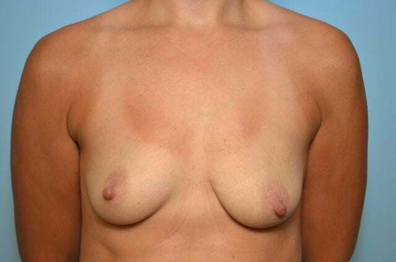 Breast Augmentation Before & After Gallery - Patient 340471 - Image 1