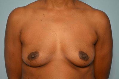 Breast Augmentation Before & After Gallery - Patient 203773 - Image 1