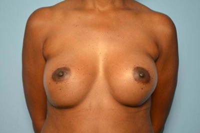 Breast Augmentation Before & After Gallery - Patient 203773 - Image 2
