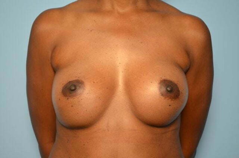 Breast Augmentation Before & After Gallery - Patient 203773 - Image 2