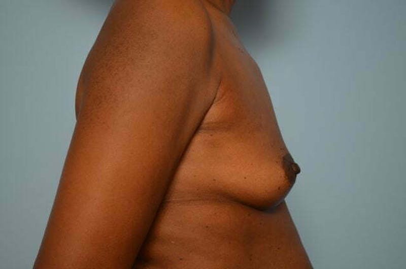 Breast Augmentation Before & After Gallery - Patient 203773 - Image 5