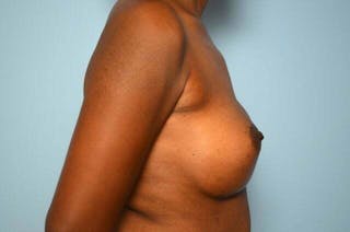 Breast Augmentation Before & After Gallery - Patient 203773 - Image 6