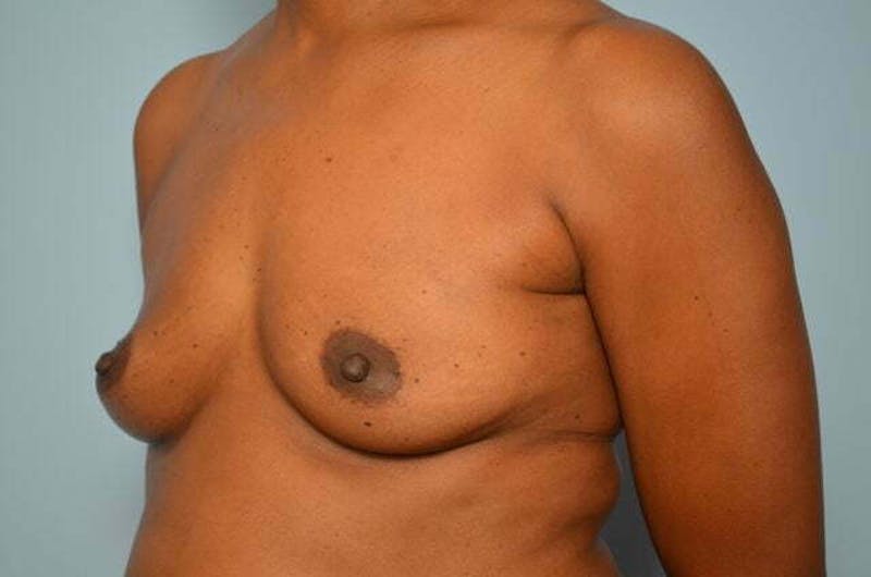 Breast Augmentation Before & After Gallery - Patient 203773 - Image 7
