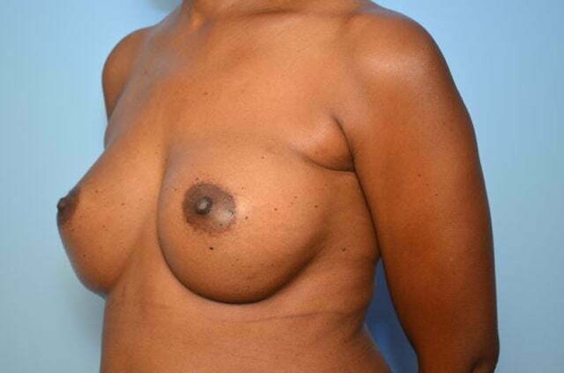 Breast Augmentation Before & After Gallery - Patient 203773 - Image 8