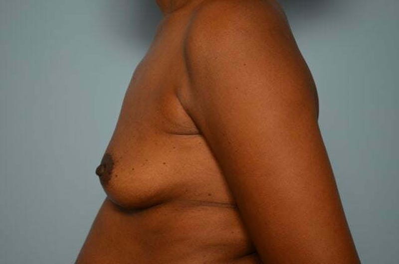 Breast Augmentation Before & After Gallery - Patient 203773 - Image 9