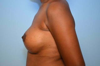 Breast Augmentation Before & After Gallery - Patient 203773 - Image 10