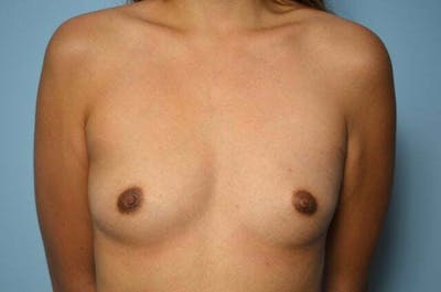 Breast Augmentation Before & After Gallery - Patient 128049 - Image 1