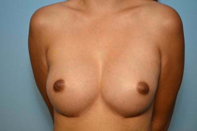 Breast Augmentation Before & After Gallery - Patient 128049 - Image 2