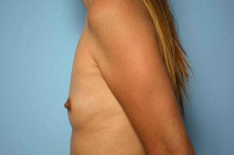 Breast Augmentation Before & After Gallery - Patient 128049 - Image 9