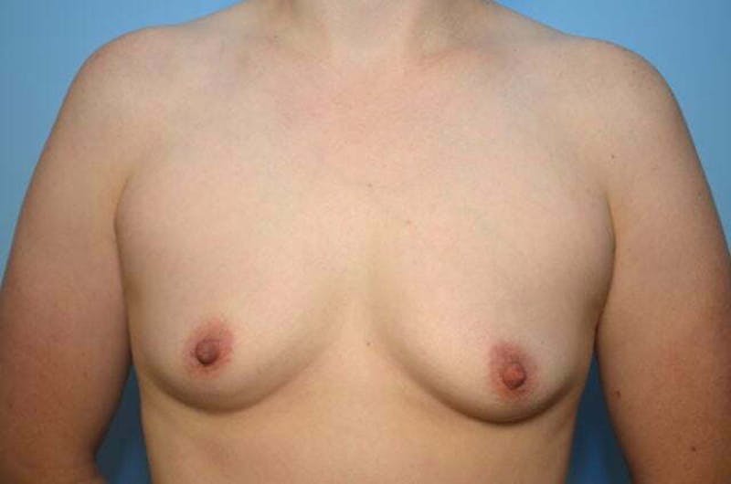 Breast Augmentation Before & After Gallery - Patient 366086 - Image 1