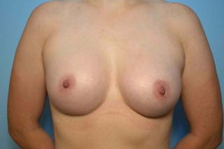 Breast Augmentation Before & After Gallery - Patient 366086 - Image 2