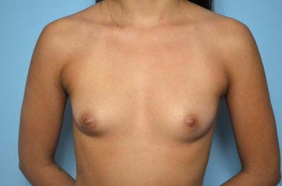 Breast Augmentation Before & After Gallery - Patient 403775 - Image 1