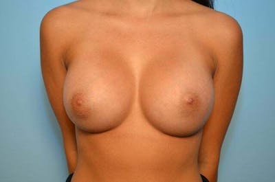 Breast Augmentation Before & After Gallery - Patient 403775 - Image 2