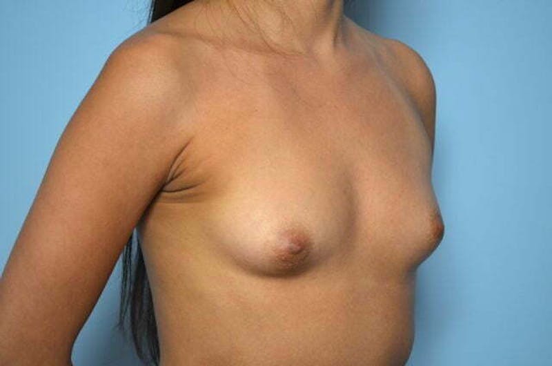 Breast Augmentation Before & After Gallery - Patient 403775 - Image 3