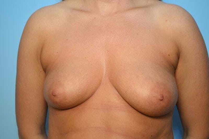 Breast Asymmetry Correction Before & After Gallery - Patient 104669 - Image 1