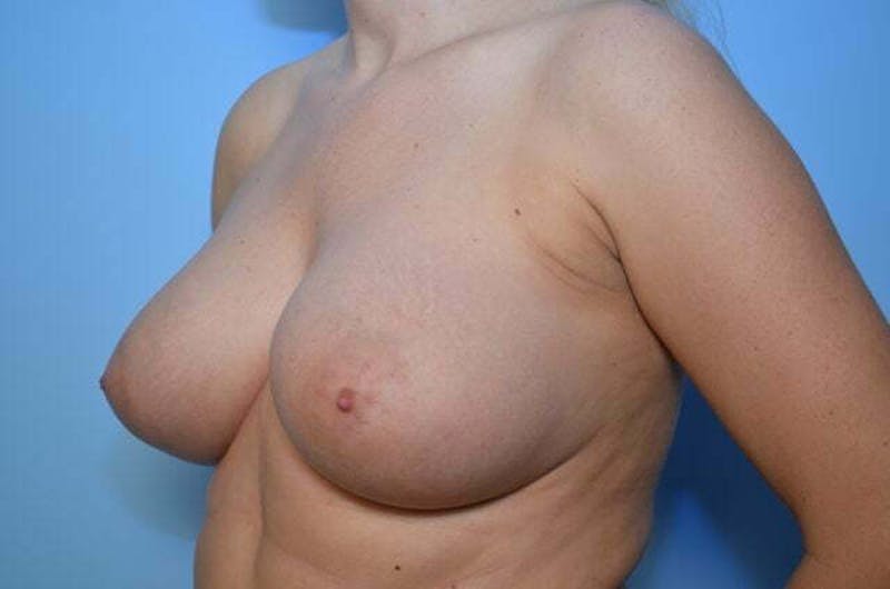 Breast Asymmetry Correction Before & After Gallery - Patient 104669 - Image 8