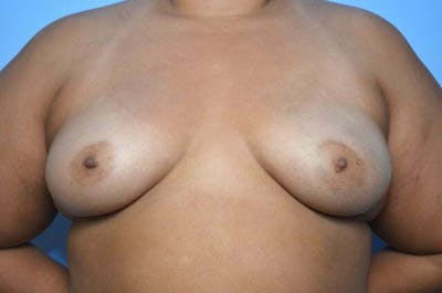 Breast Augmentation Before & After Gallery - Patient 273163 - Image 1