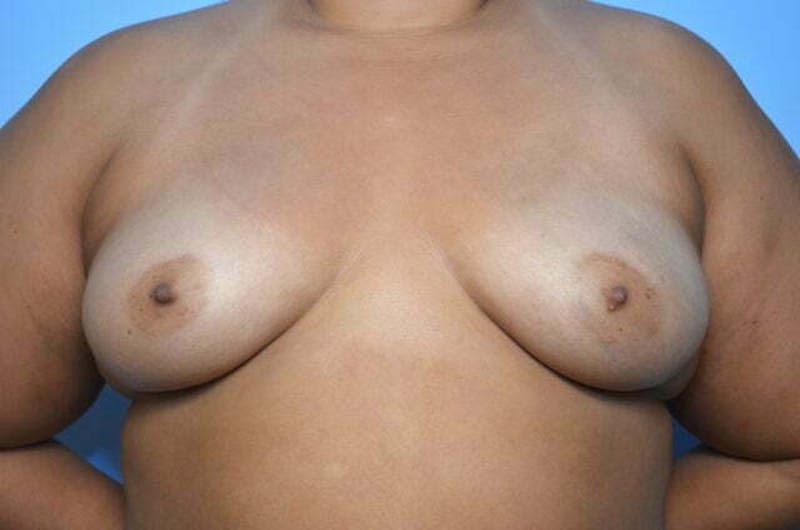 Breast Augmentation Before & After Gallery - Patient 273163 - Image 1