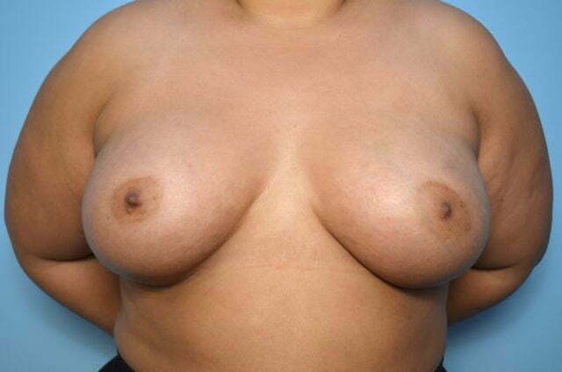 Breast Augmentation Before & After Gallery - Patient 273163 - Image 2