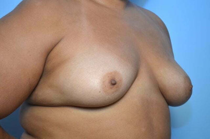 Breast Augmentation Before & After Gallery - Patient 273163 - Image 3