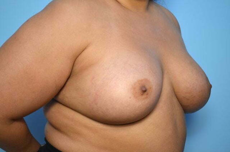 Breast Augmentation Before & After Gallery - Patient 273163 - Image 4