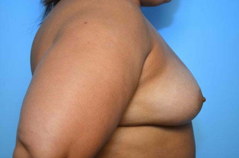 Breast Augmentation Before & After Gallery - Patient 273163 - Image 5