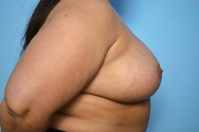 Breast Augmentation Before & After Gallery - Patient 273163 - Image 6