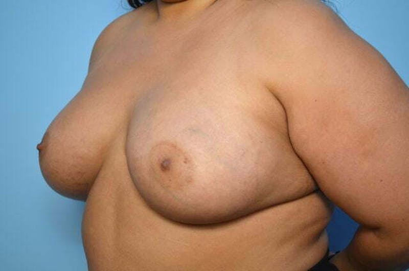 Breast Augmentation Before & After Gallery - Patient 273163 - Image 8
