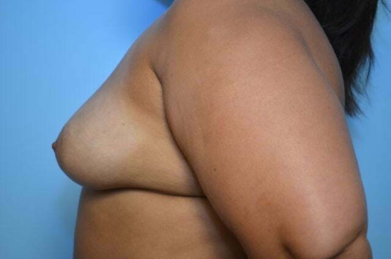 Breast Augmentation Before & After Gallery - Patient 273163 - Image 9