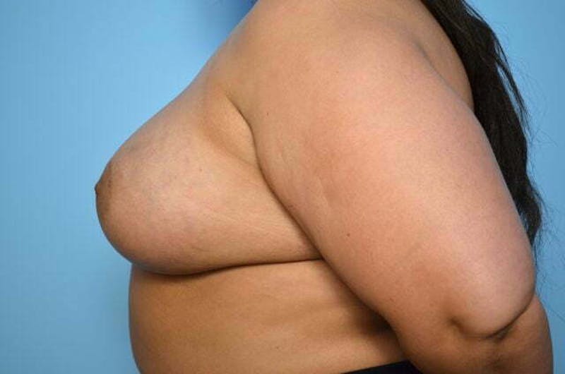 Breast Augmentation Before & After Gallery - Patient 273163 - Image 10